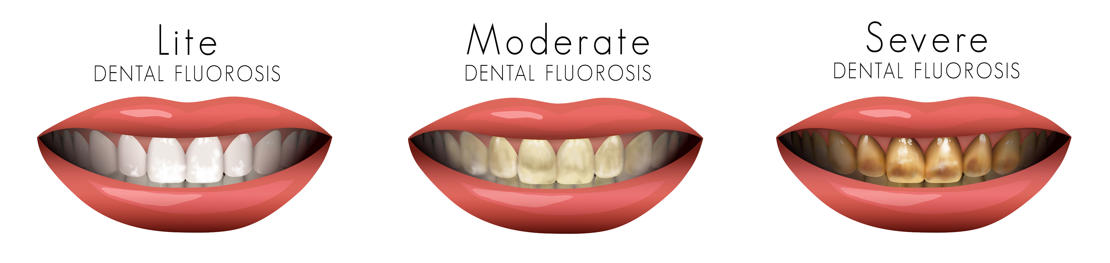 dental fluorosis chart