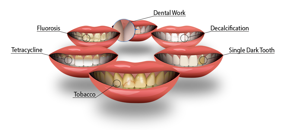 types of tooth stains