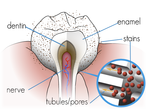 pores in teeth