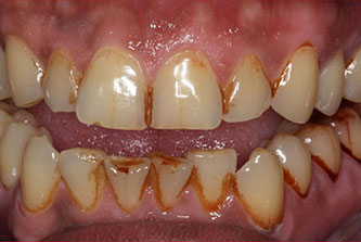 Does Nicotine Stain Your Teeth?