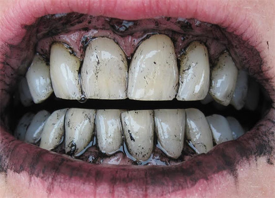 charcoal teeth whitening