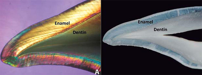 tooth enamel erosion