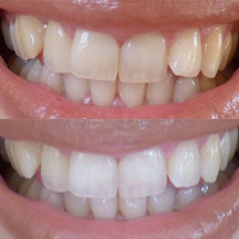 Teeth whitening and trays