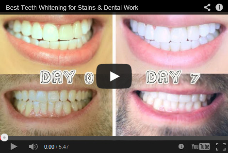 Pro white teeth whitening reviews