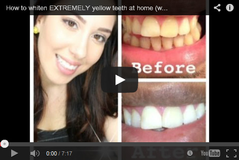 Teeth Whitening Reviews Best As Of February 21 Smile Brilliant