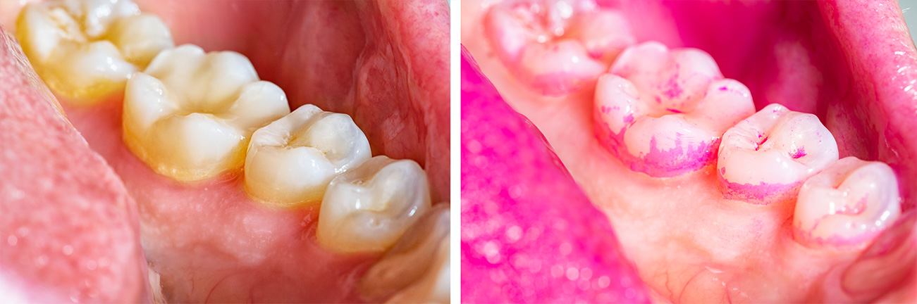 adult-grinded-teeth-1-combine
